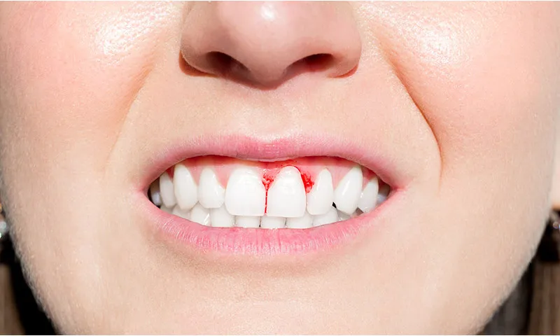 Bleeding Gums and Gum Disease