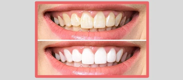 Veneers before and after