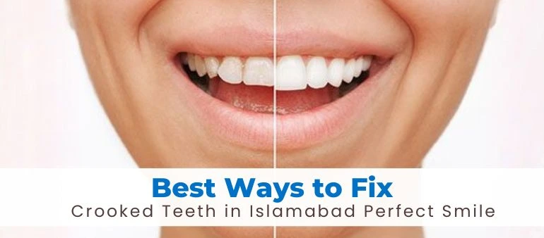 Best Ways to Fix Crooked Teeth in Islamabad Perfect Smile