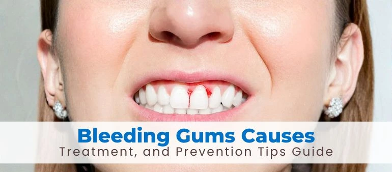 Bleeding Gums Causes, Treatment, and Prevention Tips Guide