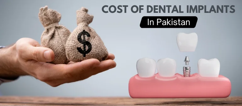 Cost of Dental Implants in Pakistan