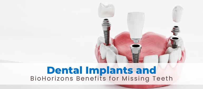Dental Implants and BioHorizons Benefits for Missing Teeth