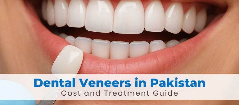 Dental Veneers in Pakistan: Cost and Treatment Guide