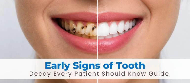 Early Signs of Tooth Decay Every Patient Should Know