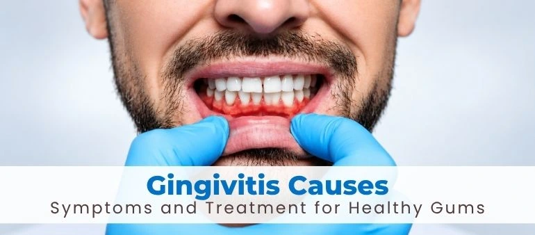 Gingivitis Causes Symptoms and Treatment for Healthy Gums