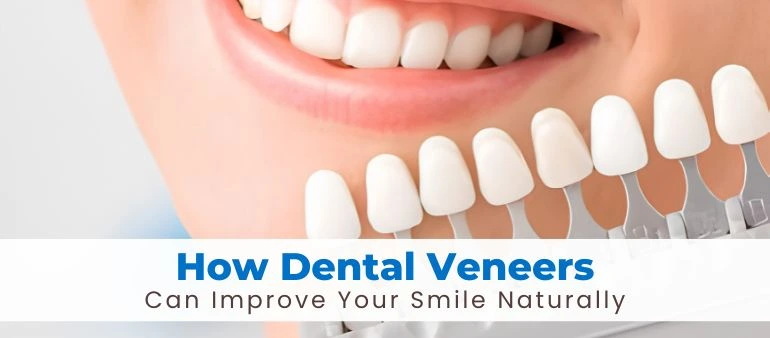 How Dental Veneers Can Improve Your Smile Naturally