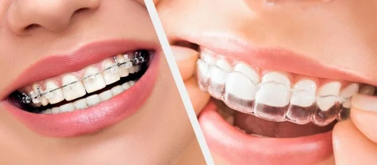 Invisalign or Braces: Best Way to Straighten Teeth