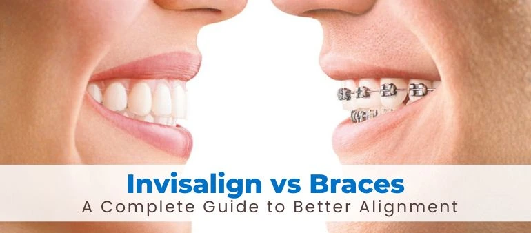Invisalign vs Braces: A Complete Guide to Better Alignment