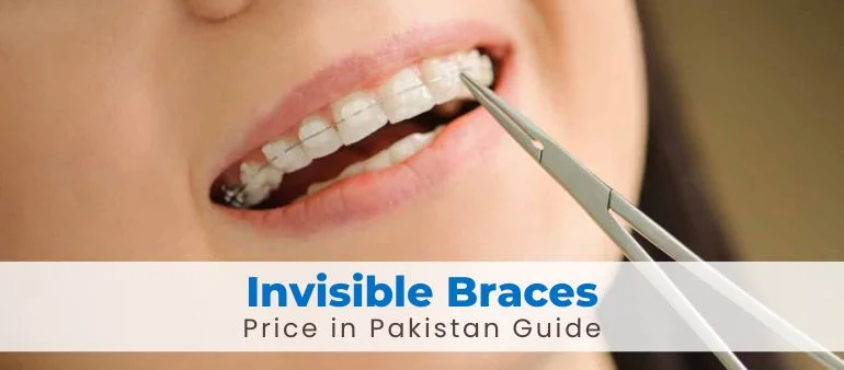 Invisible Braces Price in Pakistan Guide