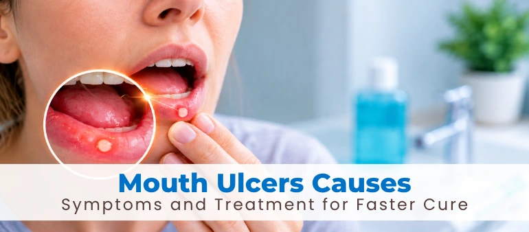 Mouth Ulcers Causes Symptoms and Treatment for Faster Cure