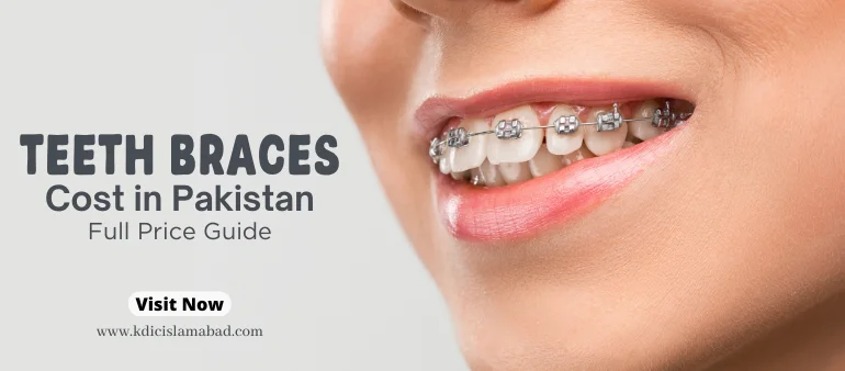 Teeth Braces Cost in Pakistan Full Price Guide