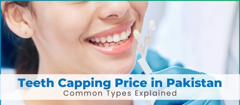 Teeth Capping Price in Pakistan and Common Types Explained