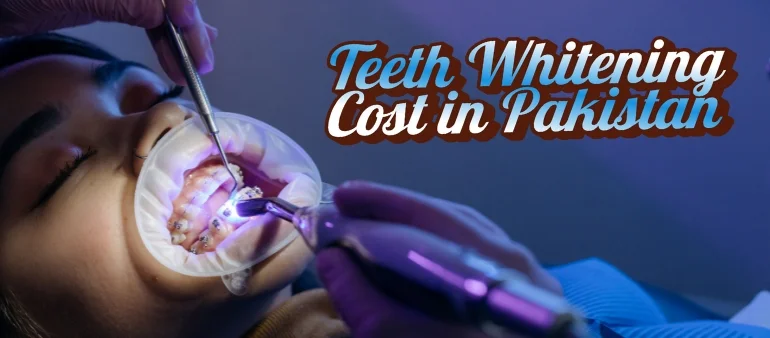 Teeth Whitening Cost in Pakistan