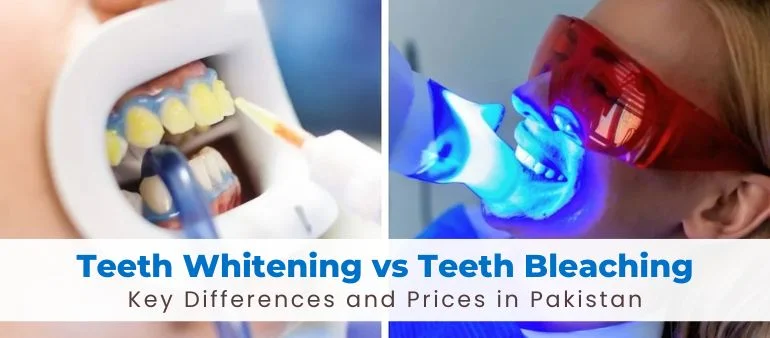 Teeth Whitening Kit vs Teeth Bleaching Kit: Key Differences and Prices