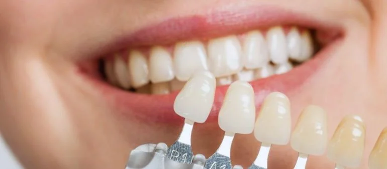 Tooth Cover Price in Pakistan | Artificial Teeth Cover at KDIC