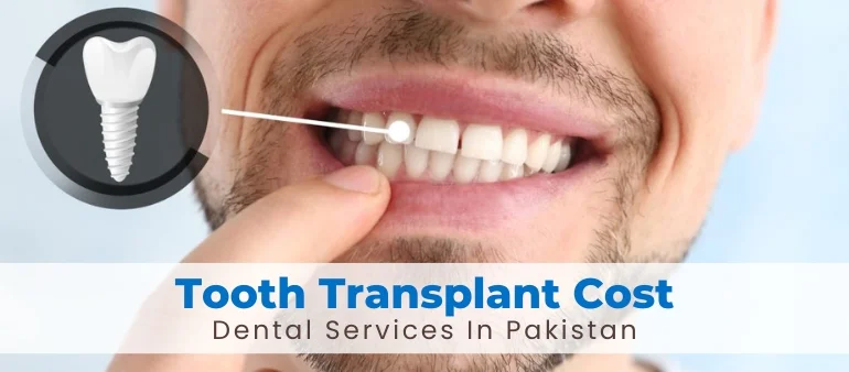 Dental Implants In Pakistan Professional Treatment