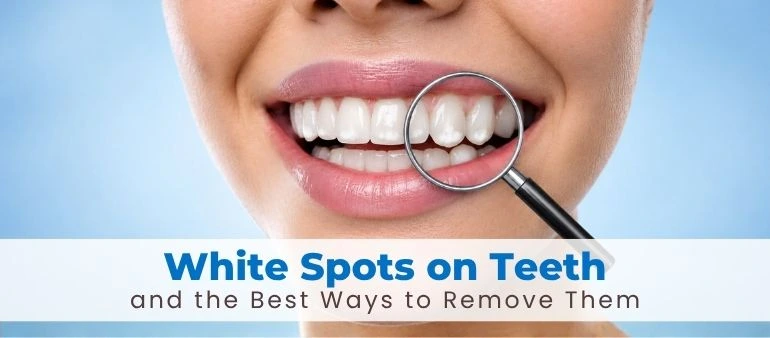 White Spots on Teeth and the Best Ways to Remove Them