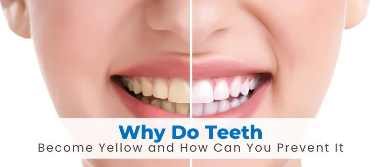 Why Do Teeth Become Yellow and How Can You Prevent It