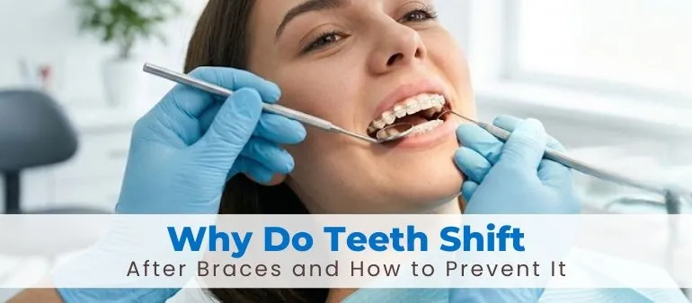 Why Do Teeth Shift After Braces and How to Prevent It
